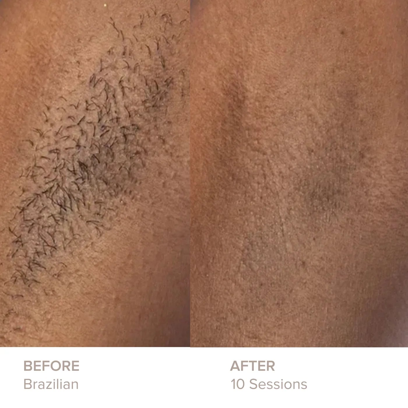 Brazilian before and after 10 sessions of laser hair removal at Semper Laser