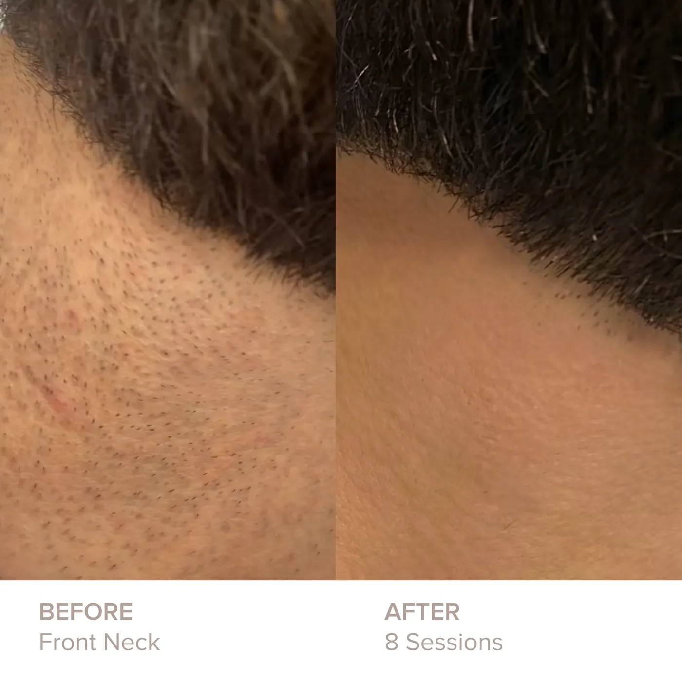 Front Neck before and after 8 sessions of laser hair removal at Semper Laser