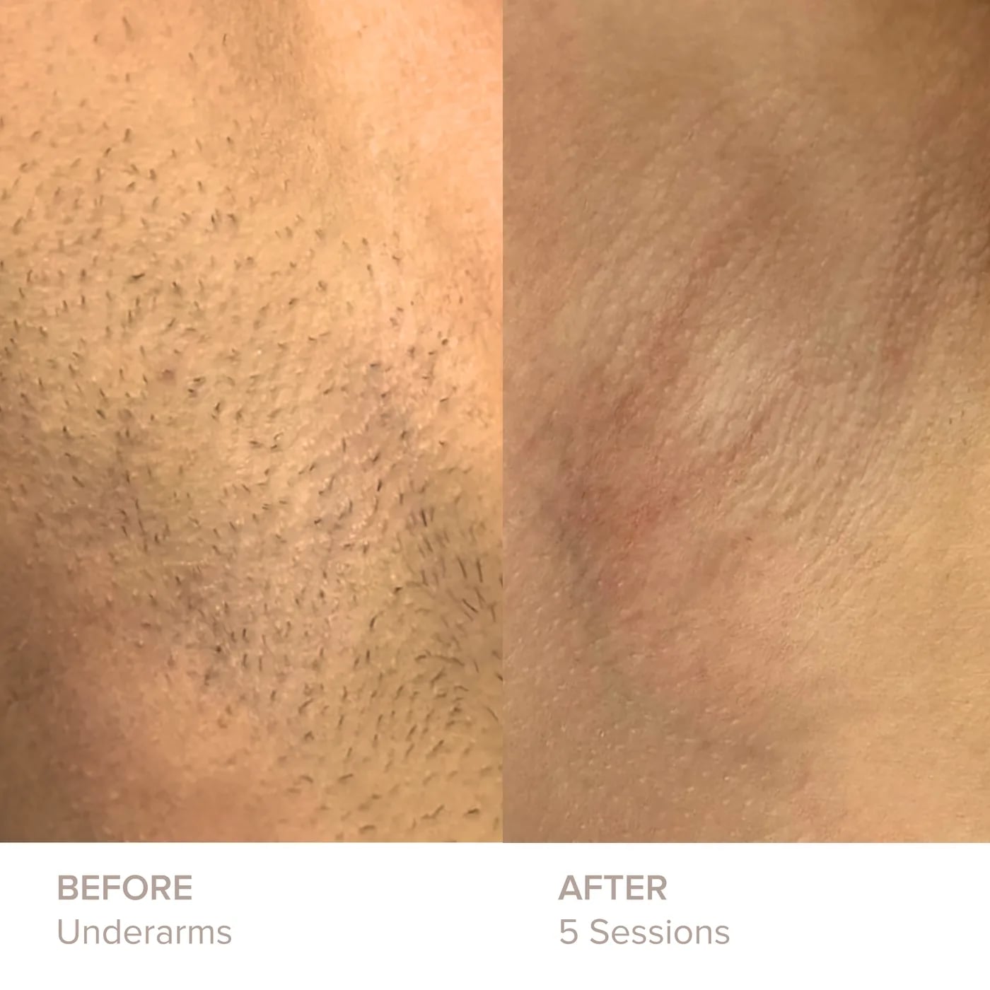 Underarms before and after 5 sessions of laser hair removal at Semper Laser
