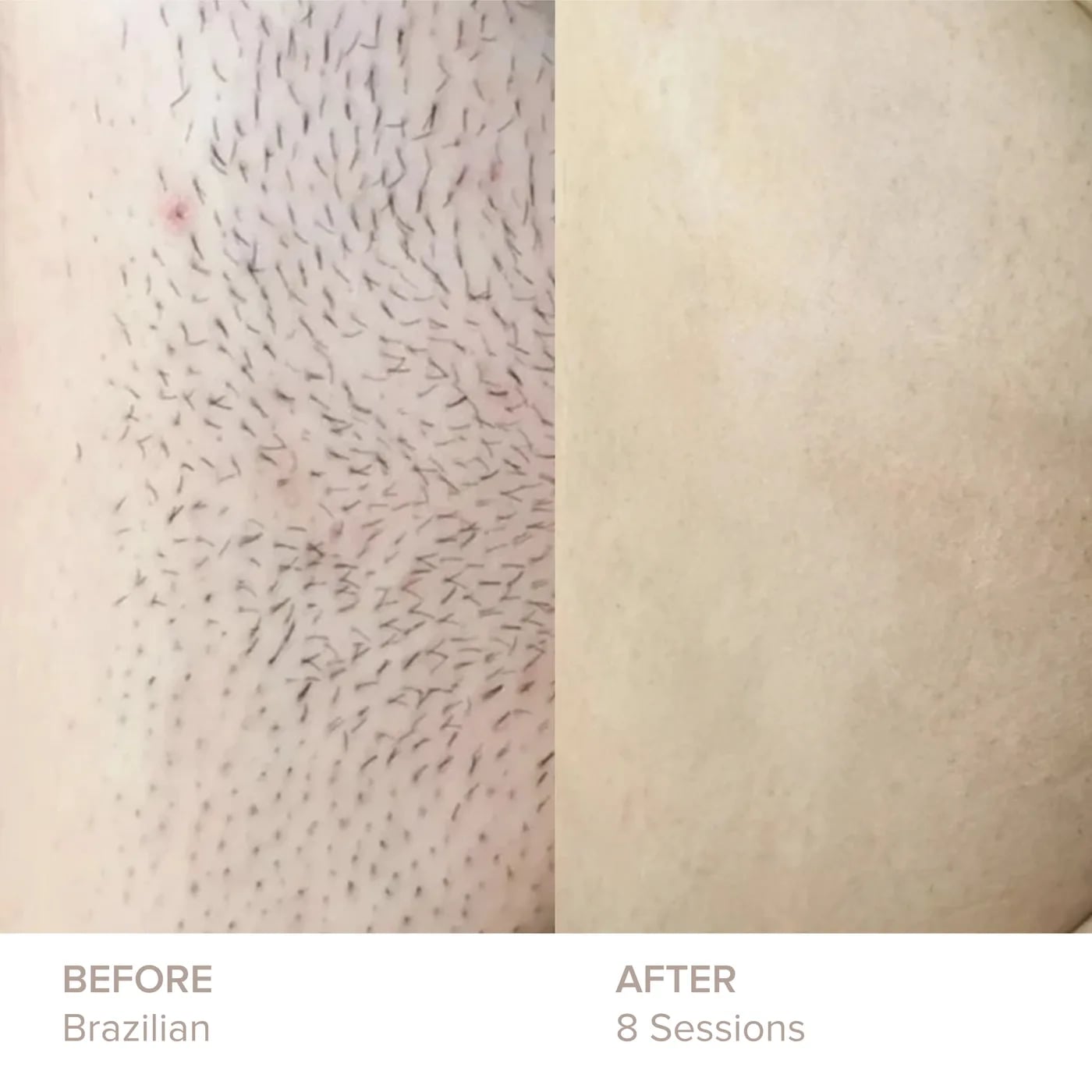 Brazilian before and after 8 sessions of laser hair removal at Semper Laser