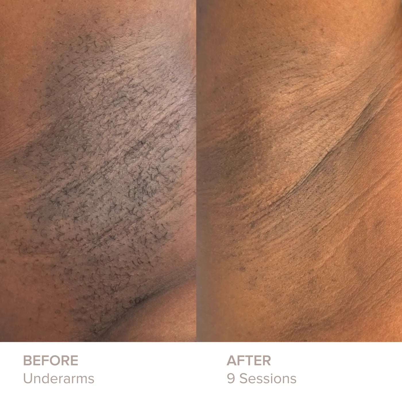 Underarms before and after 9 sessions of laser hair removal at Semper Laser