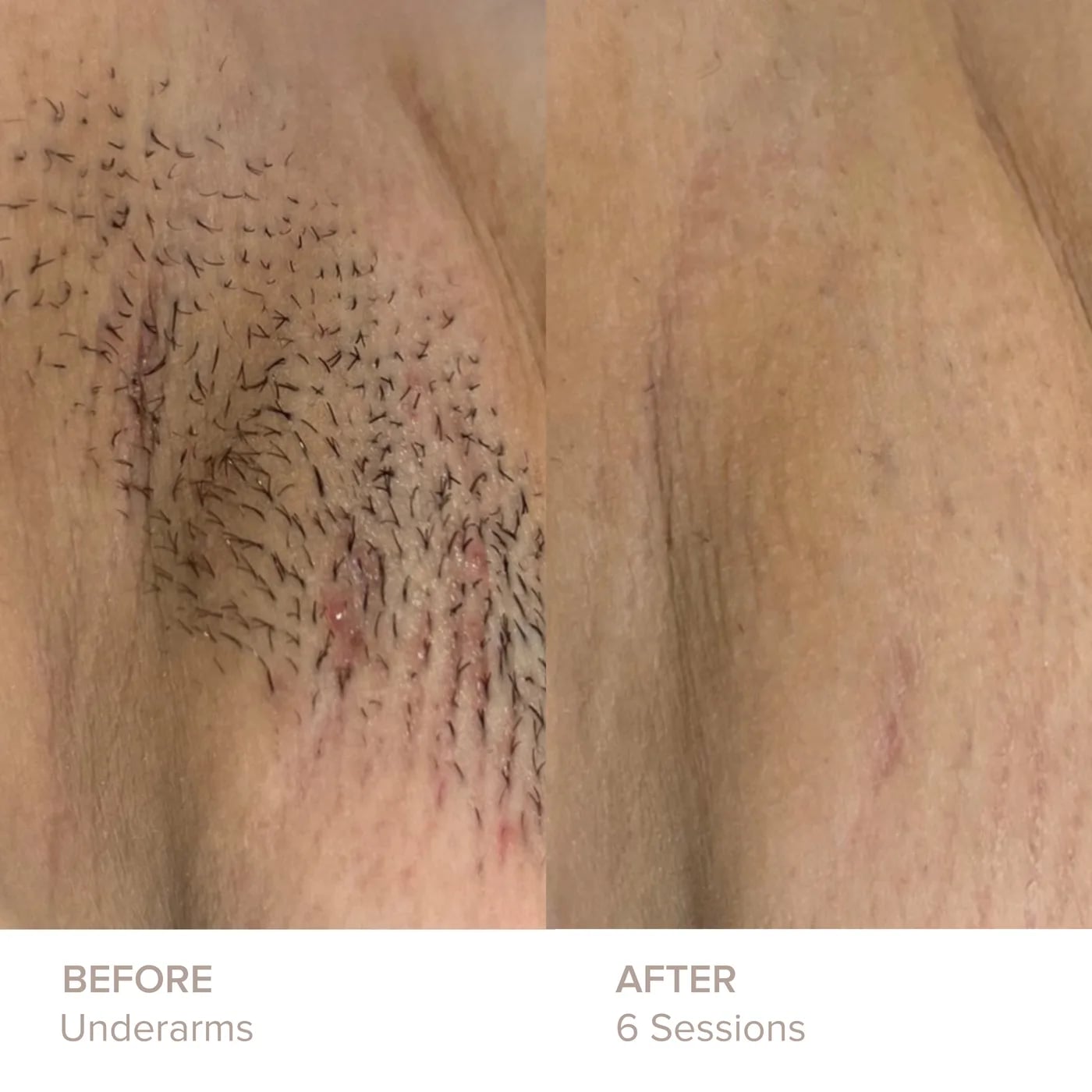 Underarms before and after 6 sessions of laser hair removal at Semper Laser