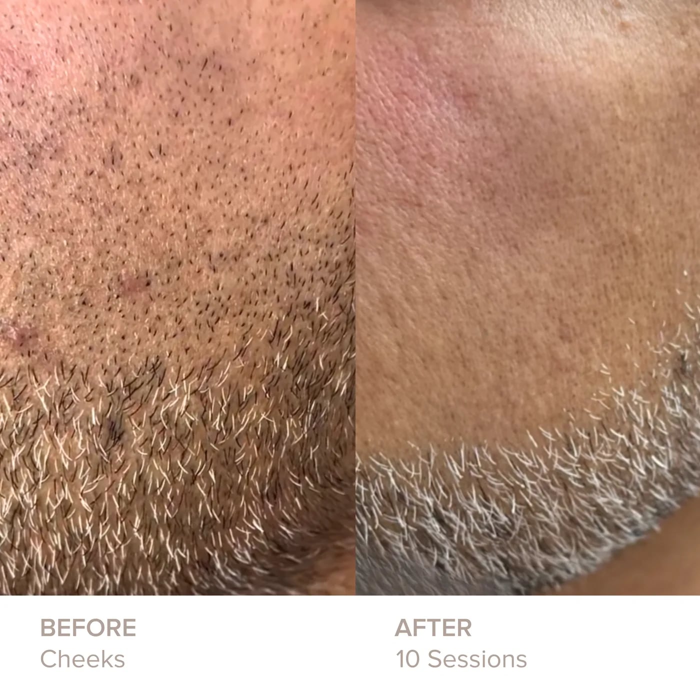 Cheeks before and after 10 sessions of laser hair removal at Semper Laser