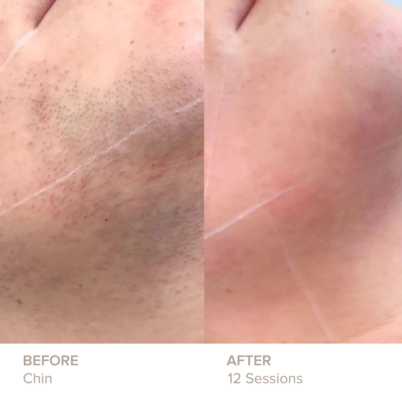 Chin before and after 12 sessions of laser hair removal at Semper Laser
